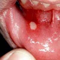 Papilloma virus e tumore alla gola - Virus hpv e tumore alla gola